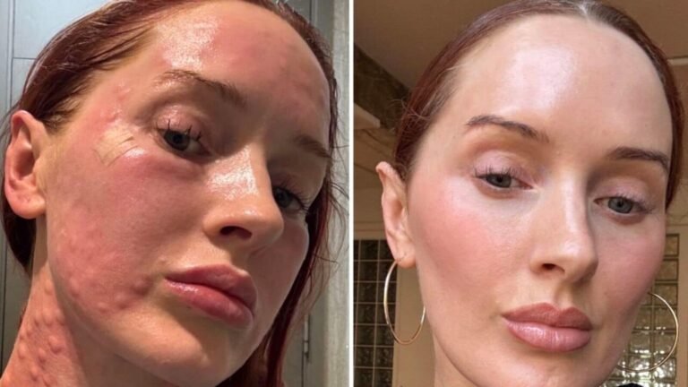 Women are flying to South Korea in droves for this painful beauty injectable